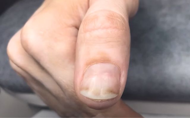 Can A Manicure Fix Burn Nails