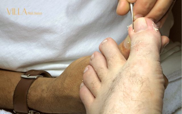 How Cutting the Sides Can Help Prevent Ingrown Toenails