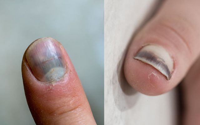What is a Smashed Finger?